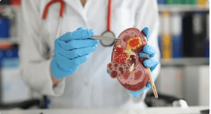 kidney stone symptoms