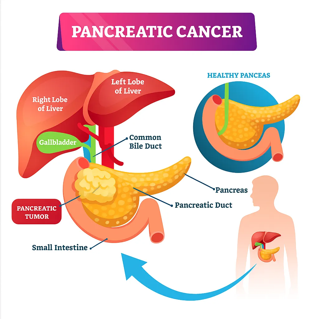 panceras cancer