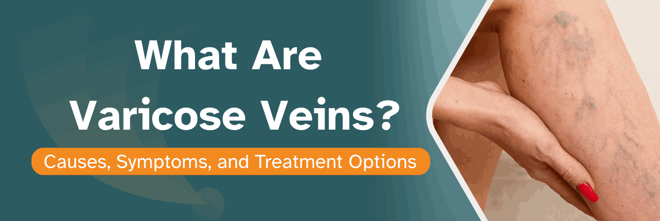 Varicose Veins Causes, Symptoms, and Treatment Options