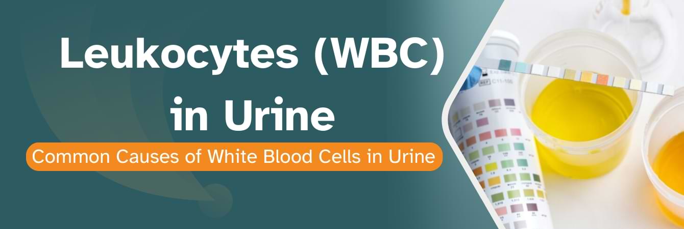 Leukocytes in Urine Common Causes of Leukocytes (White Blood Cells) in Urine