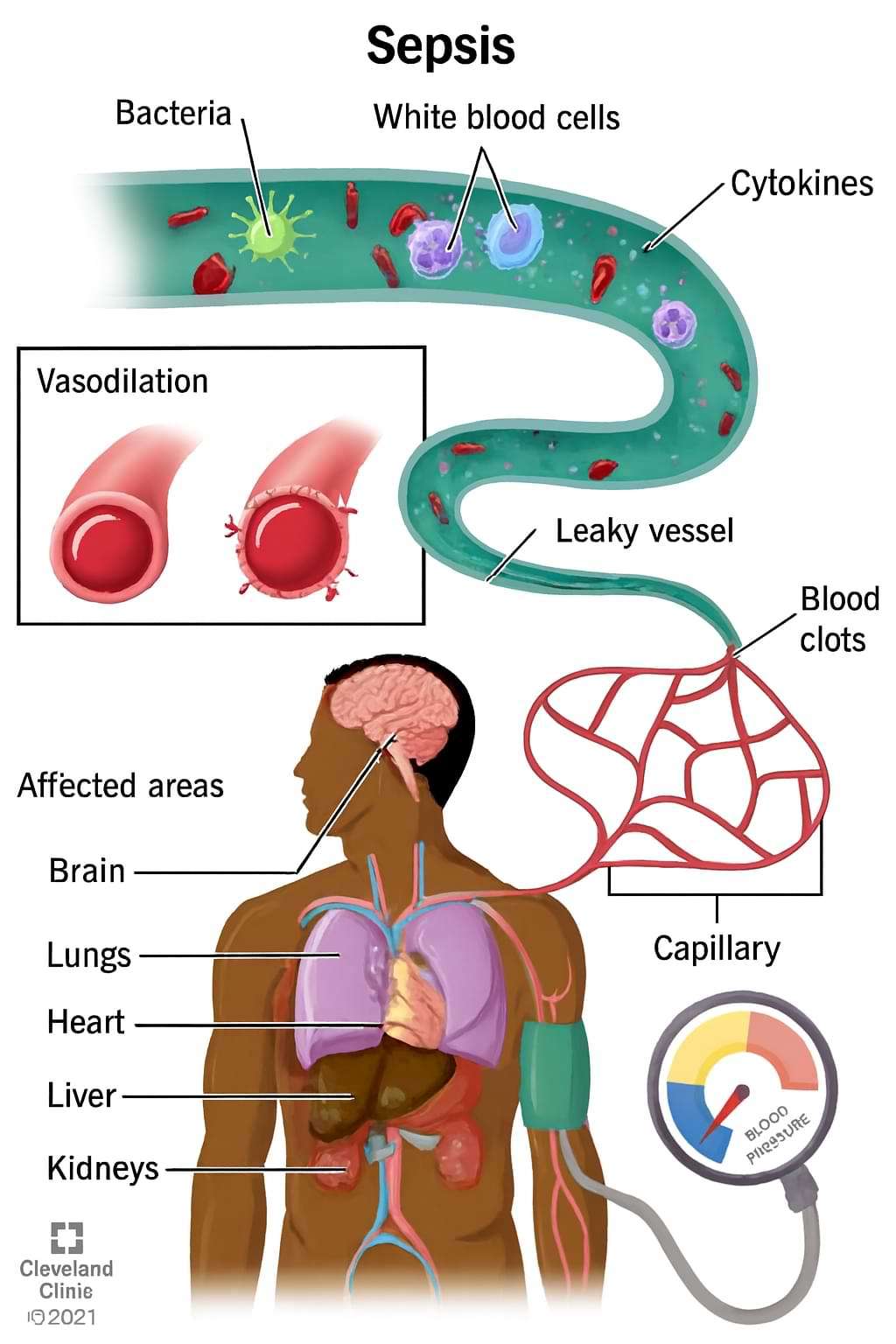 What is Sepsis & Sepsis Symptoms