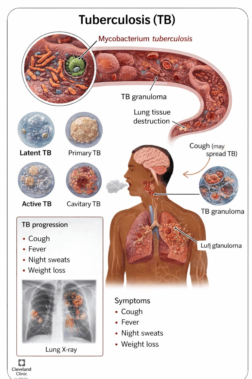 what-is-tuberculosis-tb-symptoms-causes-treatment-prevention