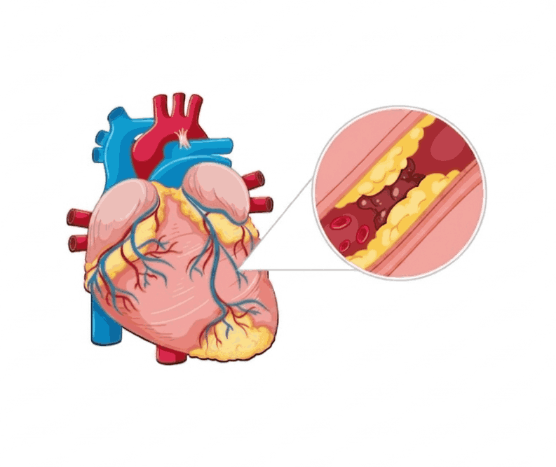 What Is Endocarditis?